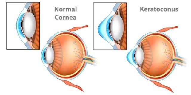 Kadinkes Inhil Ajak Masyarakat Tingkatkan Kesadaran Penyakit Keratoconus